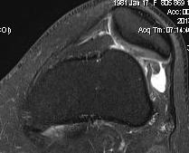 Chronic Patella Dislocation